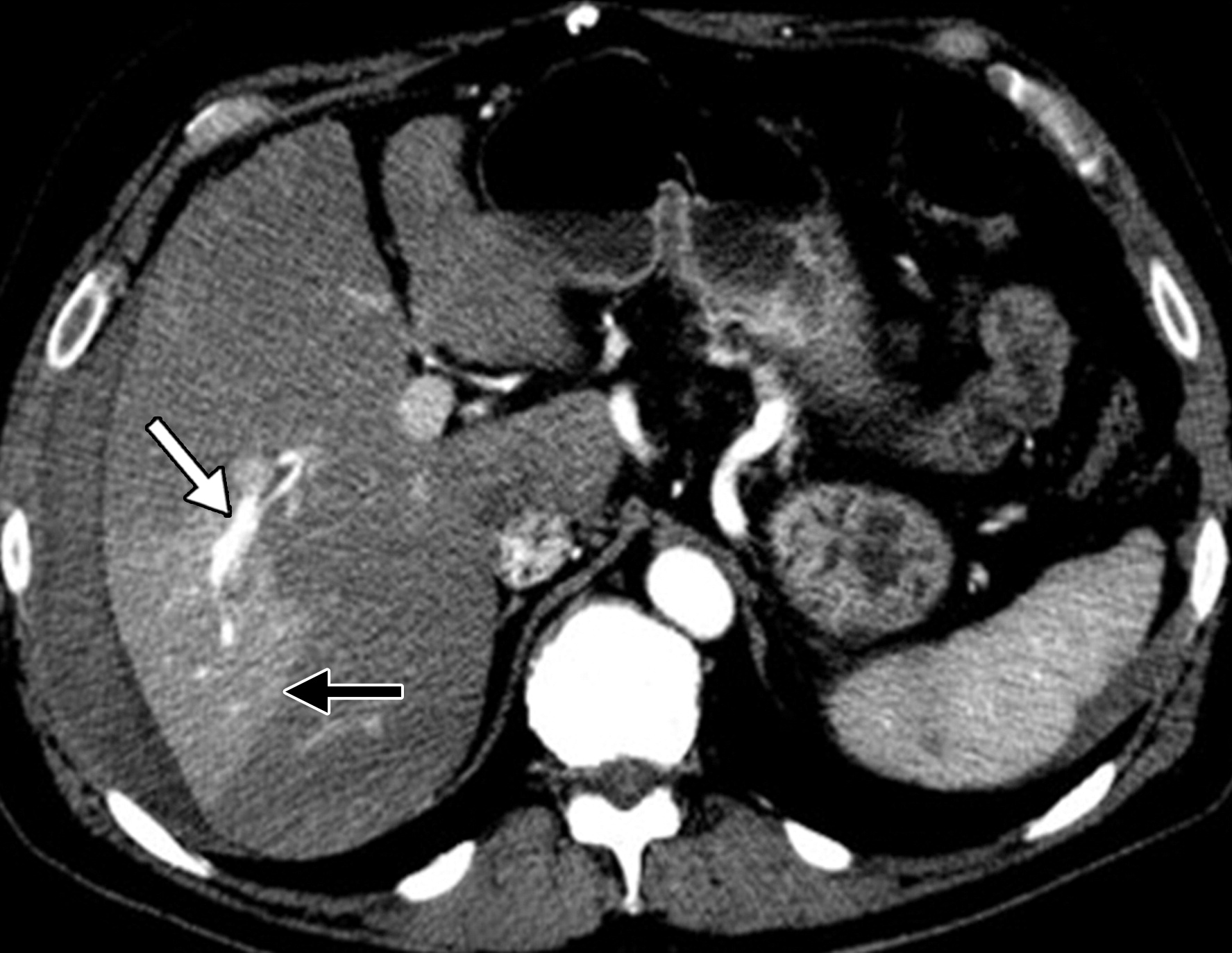 A Comprehensive Approach To Hepatic Vascular Disease Radiographics