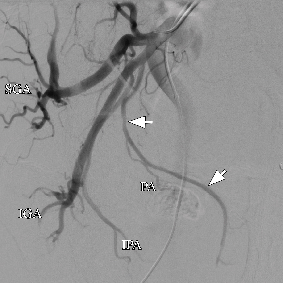 Prostatic Artery Embolization For Benign Prostatic Hyperplasia Patient Evaluation Anatomy And